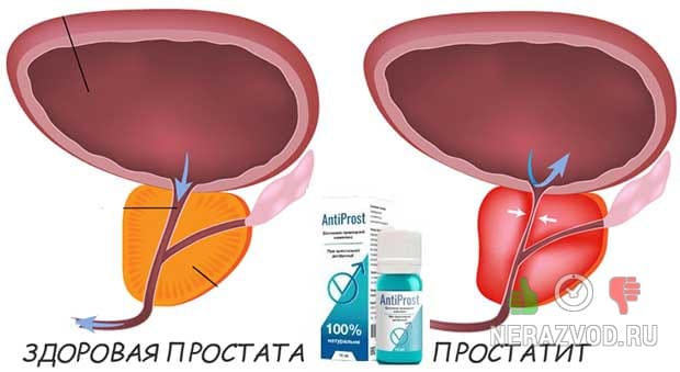 Π²ΠΎΡΠΏΠ°Π»Π΅Π½ΠΈΠ΅ Π² ΠΎΠ±Π»Π°ΡΡΠΈ ΠΏΡΠΎΡΡΠ°ΡΡ