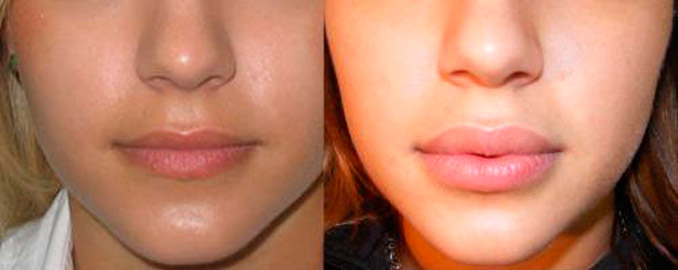 после применения геля  Perfect Lips