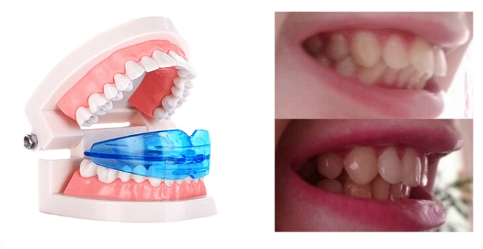 Dental Trainer для выравнивания зубов: идеальная улыбка без болевых ощущений и дискомфорта!