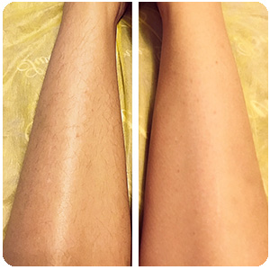 Женские ноги до и после применения depilight