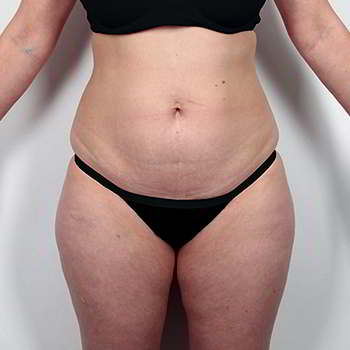 Женщина до применения капсул keto slim для похудения