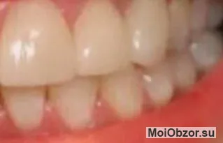 Зубы до отбеливания