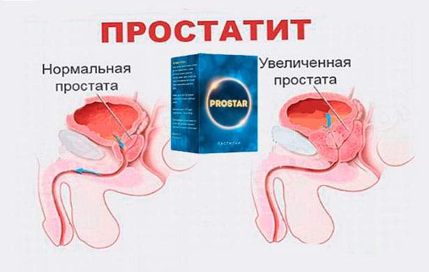 простар от простатита