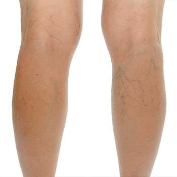 Ноги до применения крема Венорем